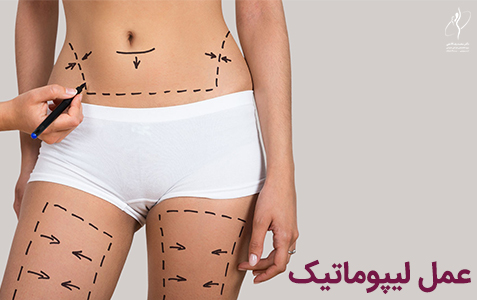 عمل لیپوماتیک | جراحی لیپوماتیک