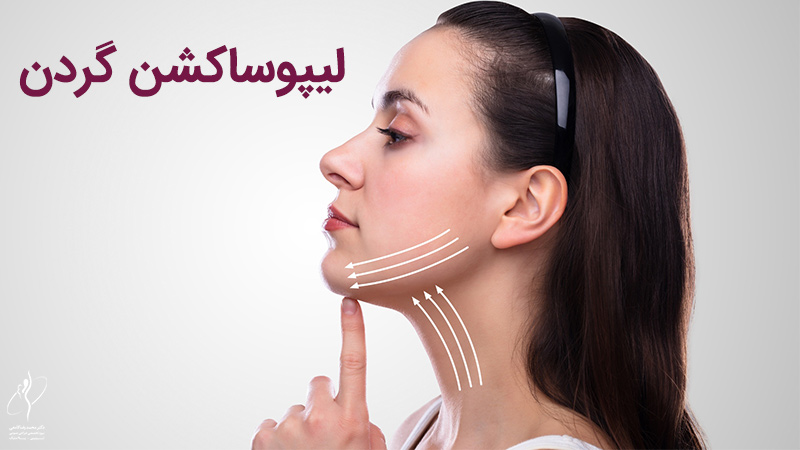 لیپوساکشن گردن