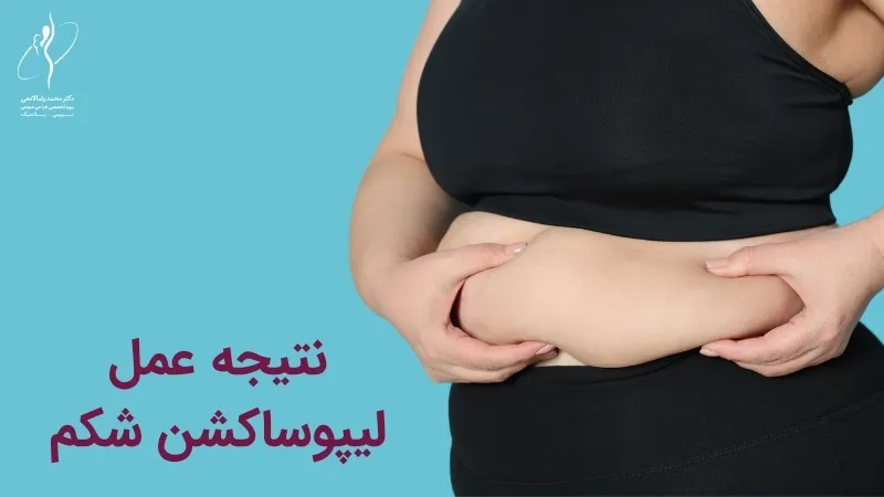 نتیجه عمل لیپوساکشن شکم