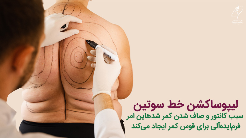 لیپوساکشن خط سوتین چیست