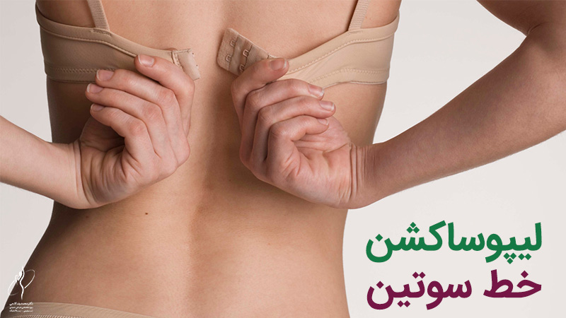 لیپوساکشن خط سوتین