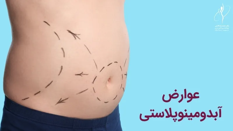 عوارض ابدومینوپلاستی